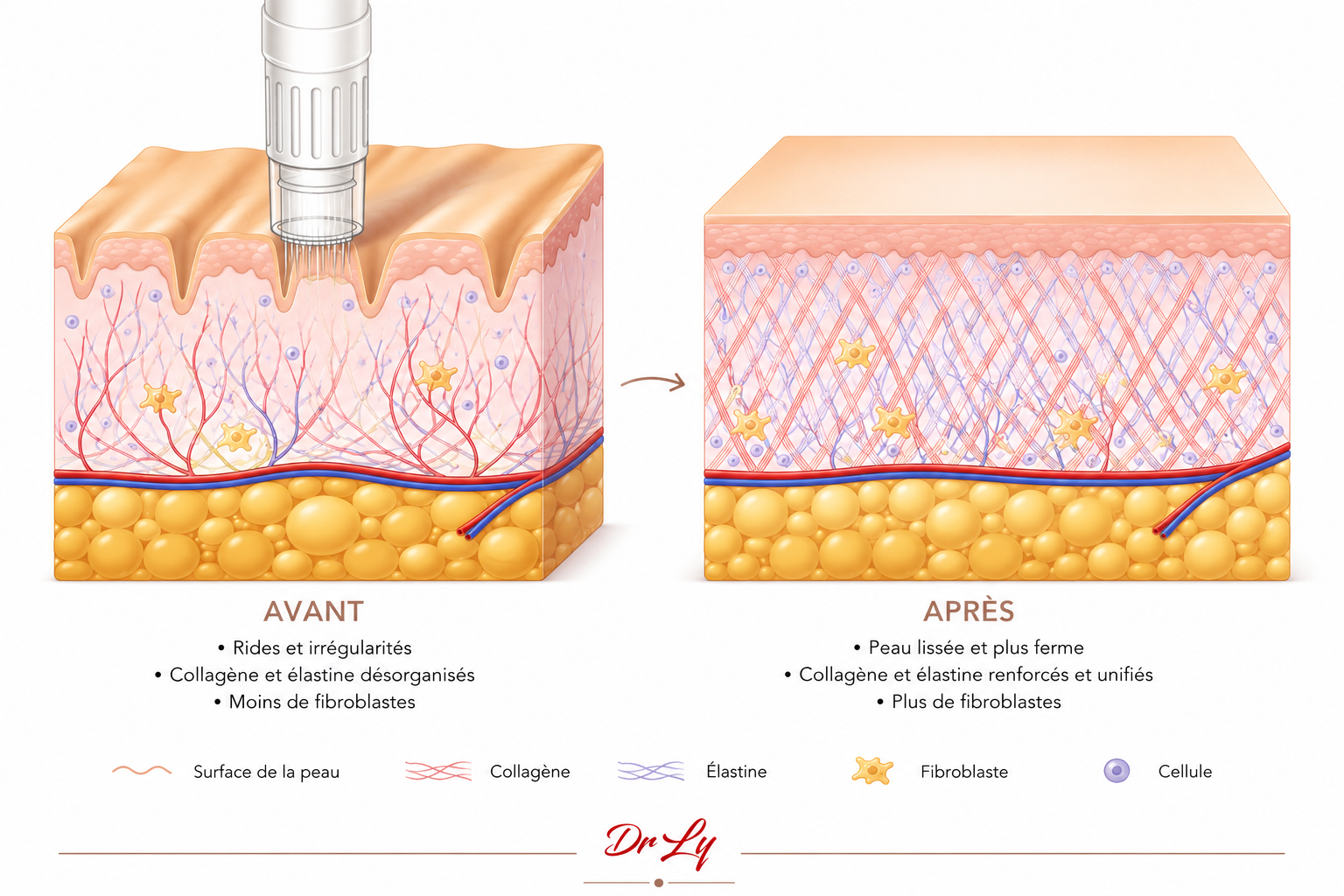 Microneedling Pontarlier, dermato pontarlier, peau